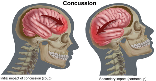 Concussion-Small.jpg